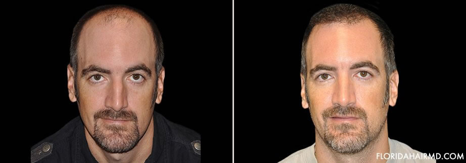 Hair Restoration Procedure Before & After