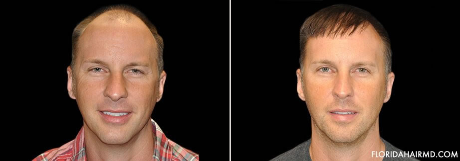 Results Of Hair Restoration Treatment